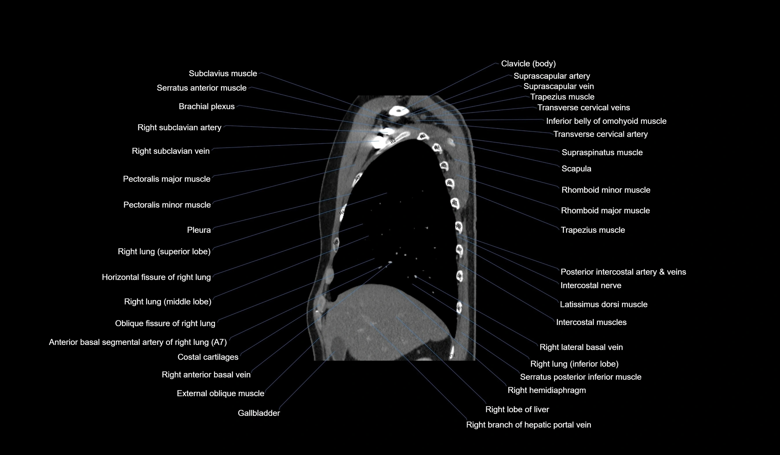 CT chest (thorax) labelled sagittal cross sectional anatomy radiology image-00037.webp